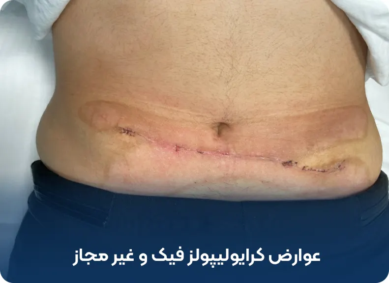 عوارض کرایولیپولیز