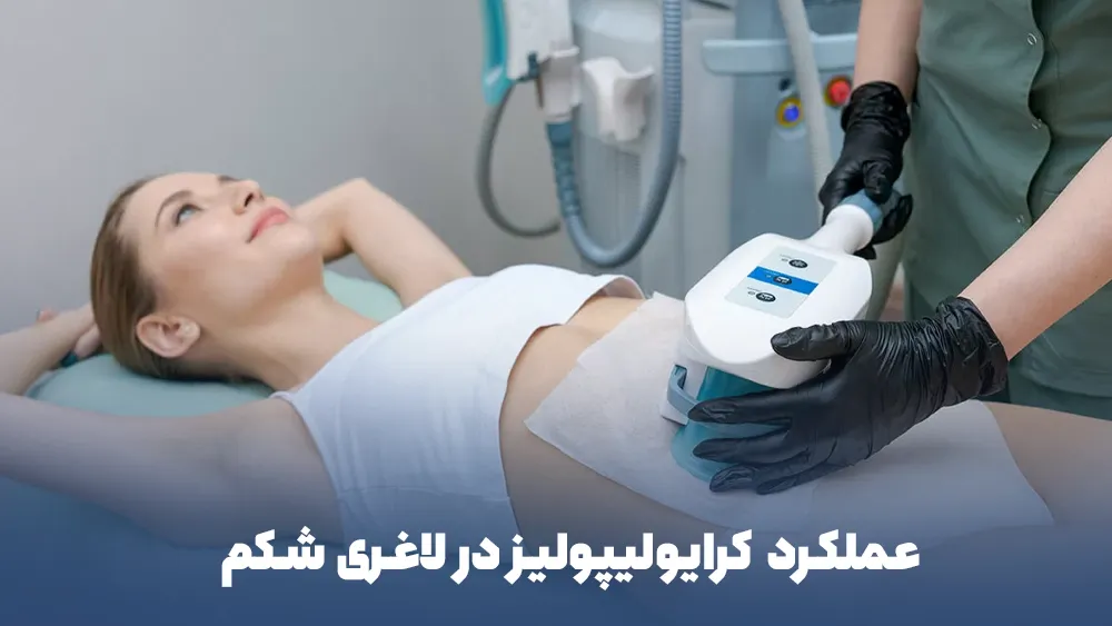 عملکرد کرایولیپولیز در لاغری شکم