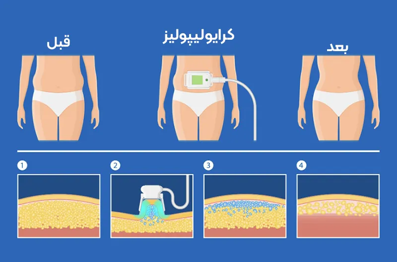 عملکرد کرایولیپولیز در لاغری شکم