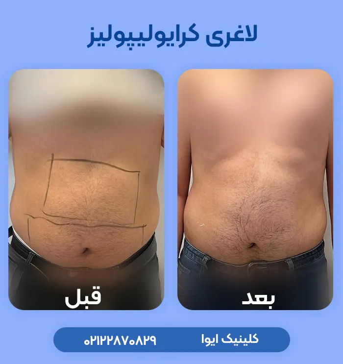 لاغری با کرایولیپولیز