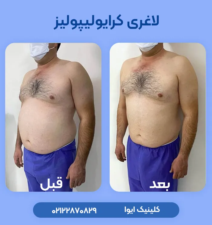 لاغری با کرایولیپولیز