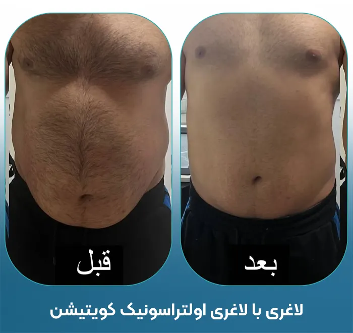 لاغری با دستگاه کویتیشن