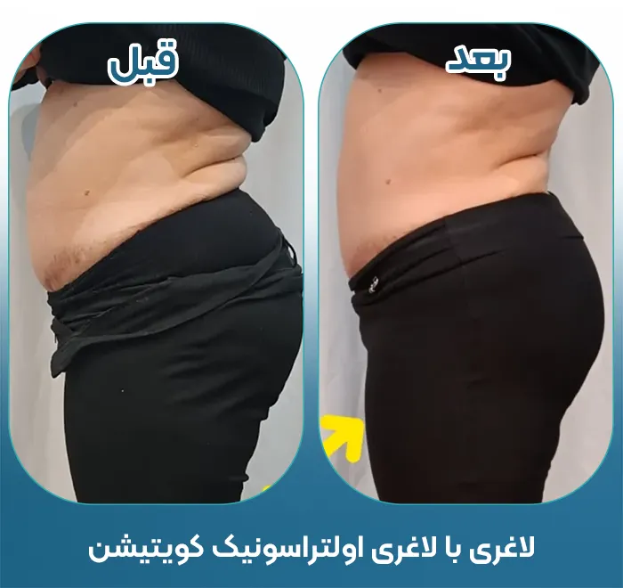 لاغری با دستگاه کویتیشن
