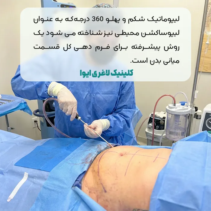 لیپوماتیک شکم و پهلو 