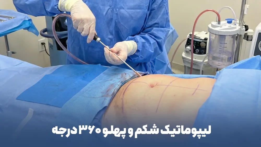 لیپوماتیک شکم و پهلو 360 درجه