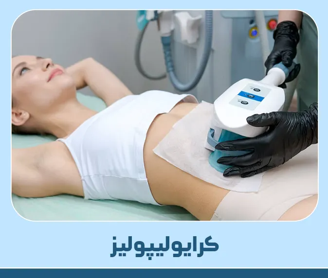 کرایولیپولیز