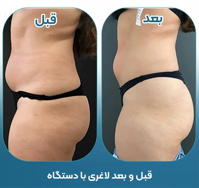 قبل و بعد لاغری با دستگاه