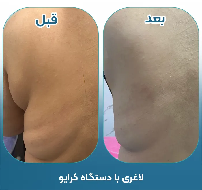 کلینیک لاغری با کرایولیپولیز