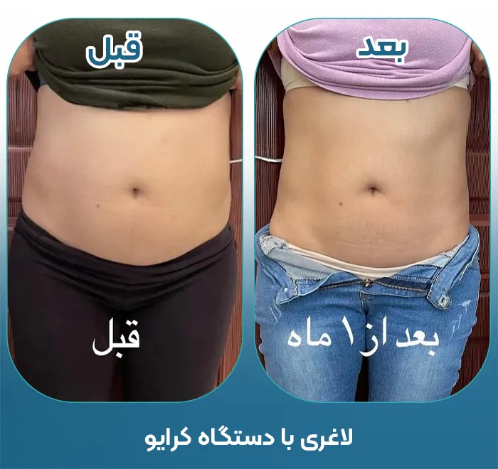 کلینیک لاغری با کرایولیپولیز