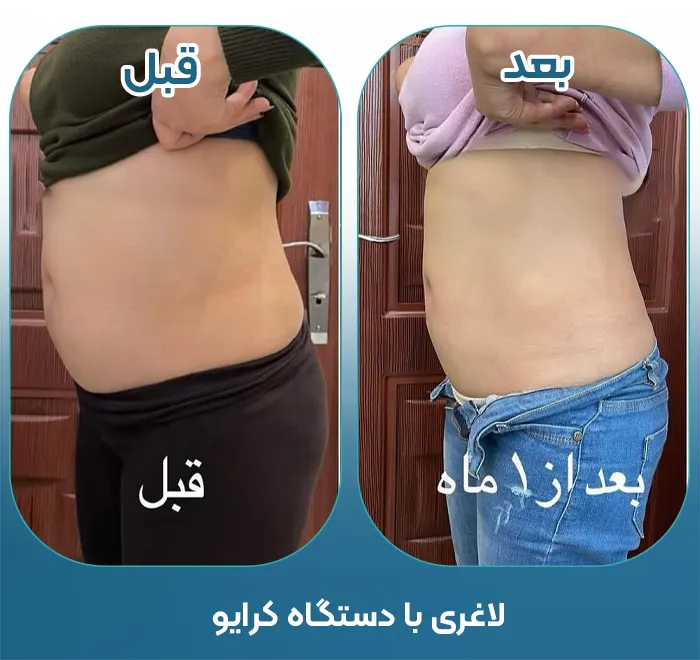 کلینیک لاغری با کرایولیپولیز