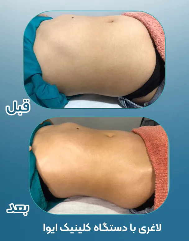 لاغری با دستگاه RF