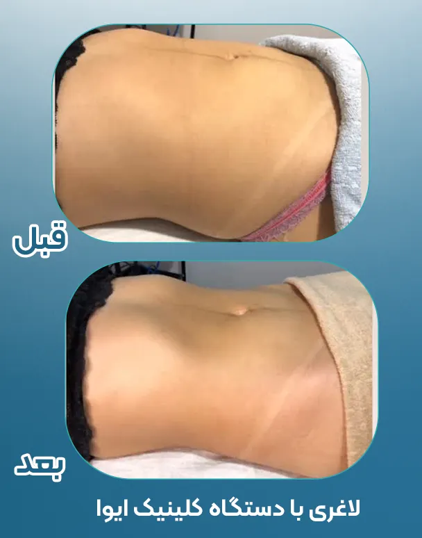 لاغری با دستگاه RF