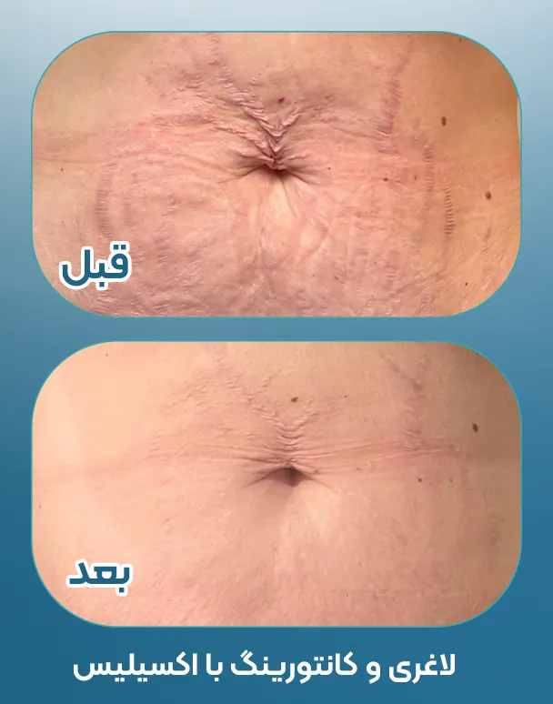 اکسیلیس برای لیفت بدن