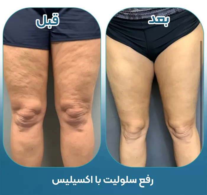 اکسیلیس برای لاغری موضعی