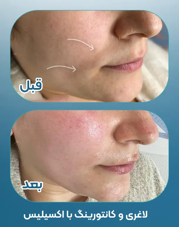 اکسیلیس برای صورت