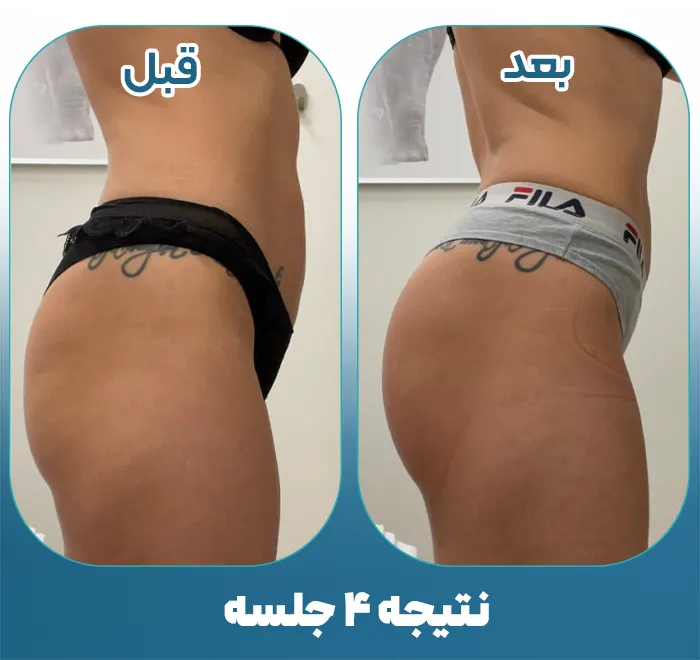 عضله سازی باسن