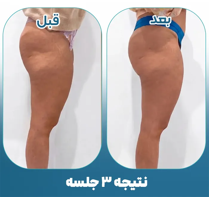 عضله سازی باسن