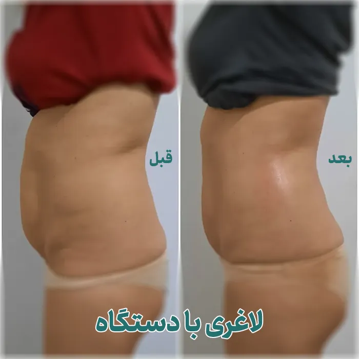قبل و بعد لاغری با دستگاه