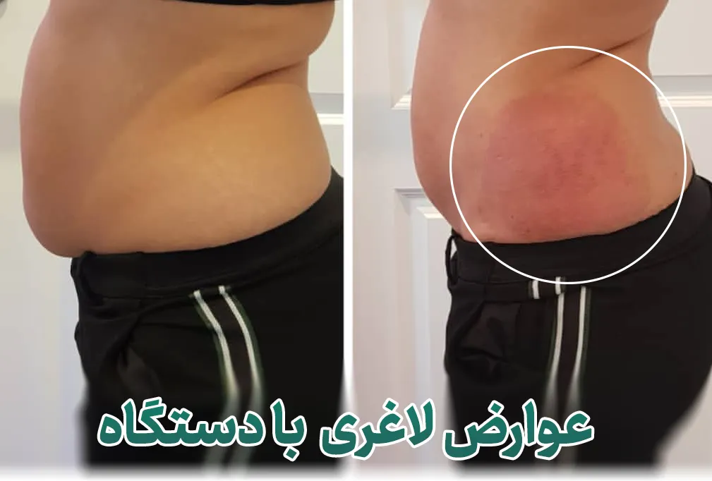 عوارض لاغری با دستگاه