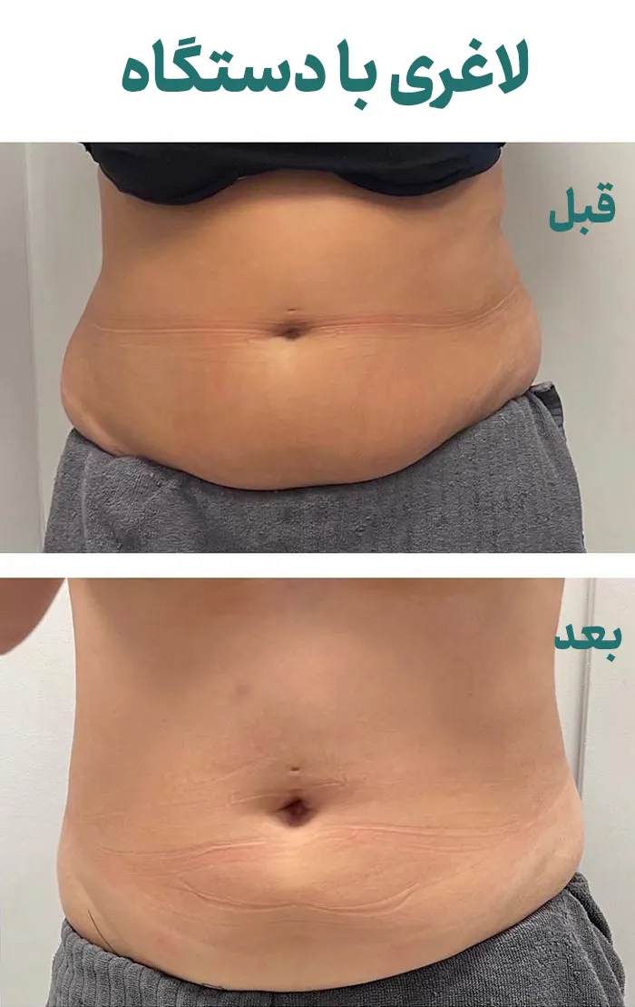 قبل و بعد لاغری با دستگاه