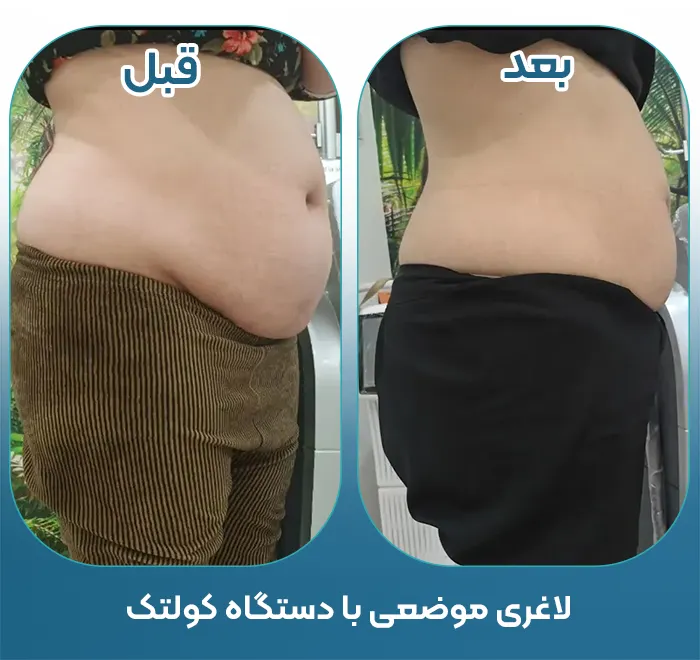 قبل و بعد لاغری با کولتک