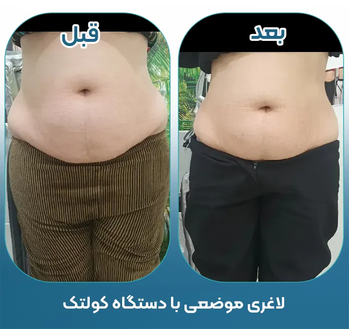 قبل و بعد لاغری با کولتک