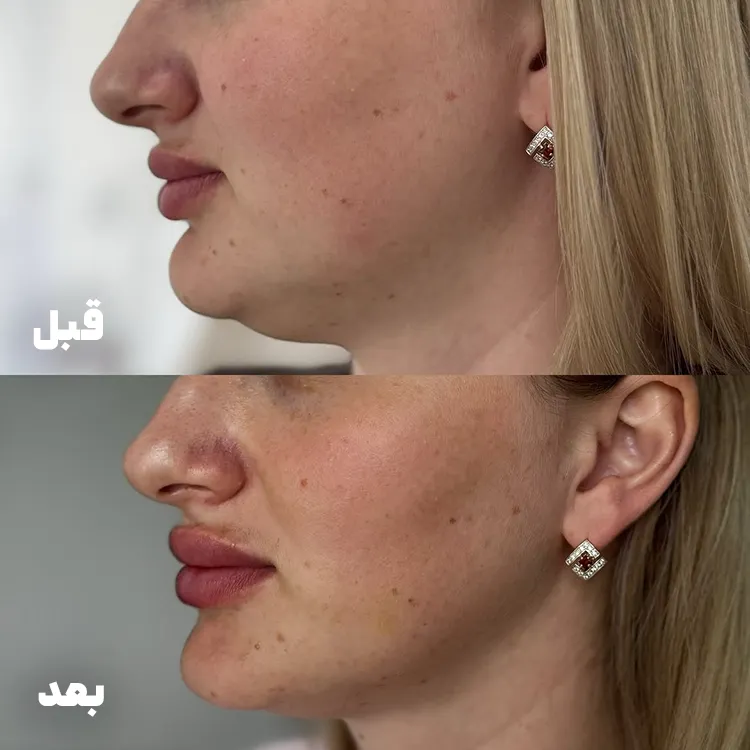 قبل و بعد مزوتراپی چربی سوز غبغب
