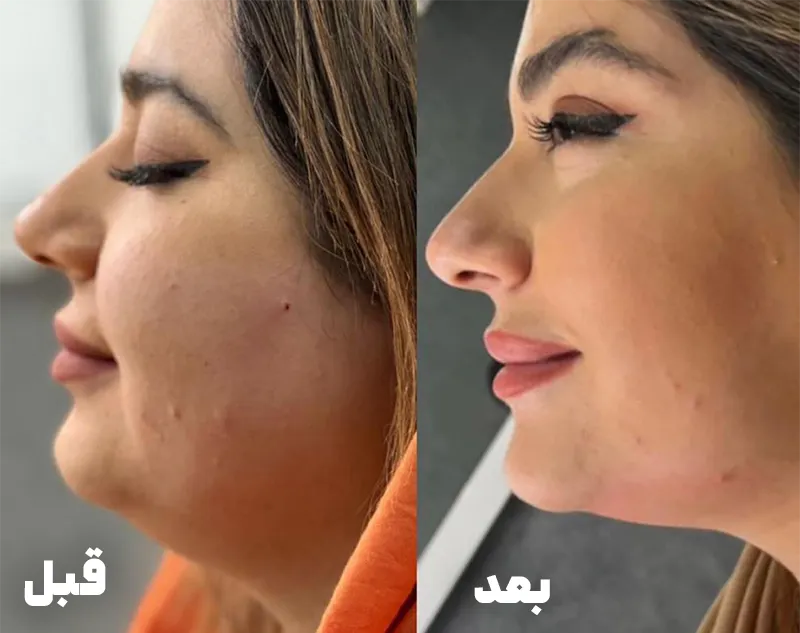 قبل و بعد مزوتراپی چربی سوز غبغب